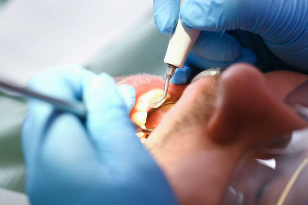 Teeth Whitening in WA