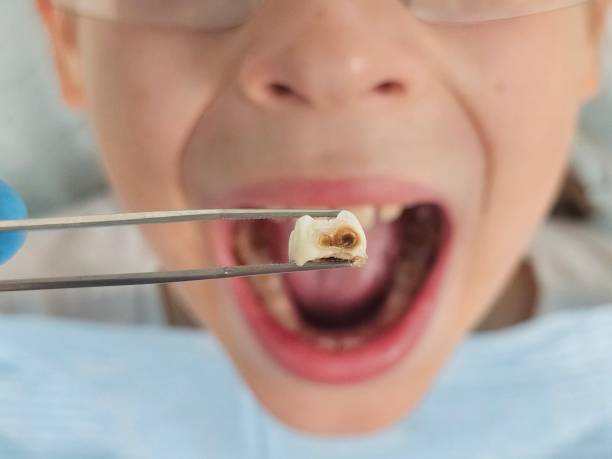 Tooth Infection Emergency Dentist in WA